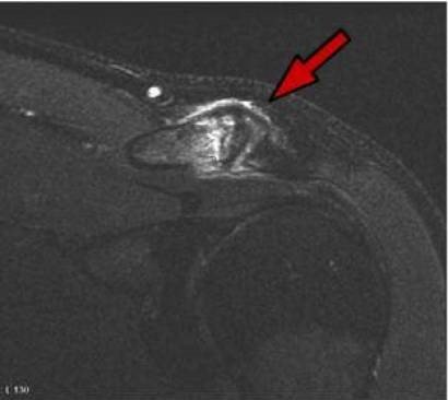 Ressonância magnética demonstrando artrose acromioclavicular