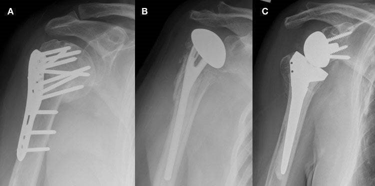 Fratura do ombro fixada com uma placa (A), substituída por uma prótese parcial (B) ou reversa do ombro (C)