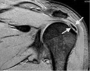 Ressonância magnética demonstrando calcificação no tendão supra-espinal